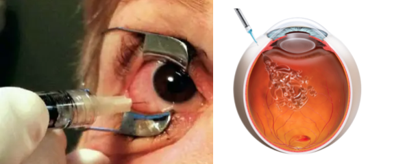 injeção intra-vítrea